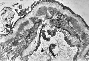  F,28y. | type I membranoproliferative glomerulonephritis